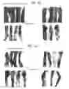 Fig. 22 - Compositions and methods to prevent cancer by stabilizing p53 through non MDM2-mediated pathways