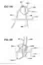 Fig. 07 - Implant having adjustable filament coils