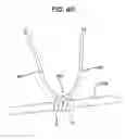 Fig. 09 - Implant having adjustable filament coils