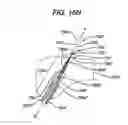 Fig. 22 - Implant having adjustable filament coils