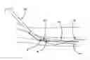 Fig. 01 - Single catheter electrode tissue cutting system for creating anastomoses