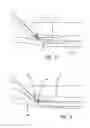 Fig. 06 - Single catheter electrode tissue cutting system for creating anastomoses