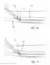 Fig. 07 - Single catheter electrode tissue cutting system for creating anastomoses