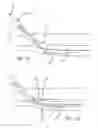 Fig. 08 - Single catheter electrode tissue cutting system for creating anastomoses