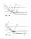 Fig. 09 - Single catheter electrode tissue cutting system for creating anastomoses