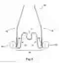 Fig. 06 - Apparatus for Applying Corrective Forces to Shape Palate