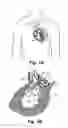 Fig. 02 - Valve For Short Time Replacement, For Taking Over The Function Of And/Or For Temporary Or Partial Support Of A Native Valve In A Heart And A Method For Delivery Therefor