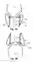 Fig. 06 - Valve For Short Time Replacement, For Taking Over The Function Of And/Or For Temporary Or Partial Support Of A Native Valve In A Heart And A Method For Delivery Therefor