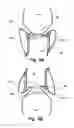 Fig. 07 - Valve For Short Time Replacement, For Taking Over The Function Of And/Or For Temporary Or Partial Support Of A Native Valve In A Heart And A Method For Delivery Therefor