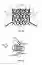 Fig. 06 - Assembly for replacing the tricuspid atrioventricular valve