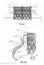 Fig. 07 - Assembly for replacing the tricuspid atrioventricular valve