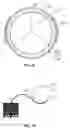 Fig. 08 - Assembly for replacing the tricuspid atrioventricular valve