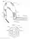 Fig. 05 - Adjustable and reversible locking mechanism for catheter-delivered implant