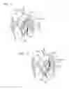 Fig. 07 - Adjustable and reversible locking mechanism for catheter-delivered implant