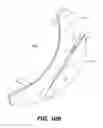 Fig. 24 - Artificial cervical and lumbar discs, disc plate insertion gun for performing sequential single plate intervertebral implantation enabling symmetric bi-disc plate alignment for interplate mobile core placement