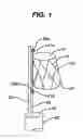 Fig. 02 - Cannulation guiding device for bifurcated stent and method of use