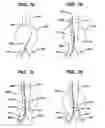 Fig. 08 - Cannulation guiding device for bifurcated stent and method of use