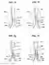 Fig. 09 - Cannulation guiding device for bifurcated stent and method of use