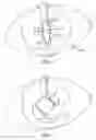 Fig. 03 - Implantation assembly for an iris-expanding device