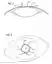 Fig. 04 - Implantation assembly for an iris-expanding device