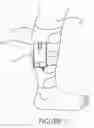 Fig. 08 - Portable intermittent pneumatic compression system