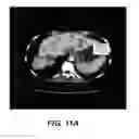 Fig. 12 - Methods for treating cancer