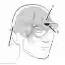 Fig. 01 - External trigeminal nerve stimulation for the acute non-invasive treatment of migraine attacks
