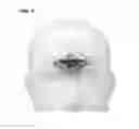 Fig. 07 - External trigeminal nerve stimulation for the acute non-invasive treatment of migraine attacks