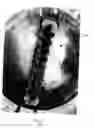 Fig. 03 - APPARATUS, SYSTEMS, AND METHODS FOR PROCESSING PLATELETS AND CONTAMINATED BLOOD