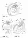 Fig. 09 - Dishwasher drain assemblies having overmolded volutes