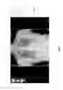 Fig. 43 - Lung screening assessment system