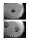 Fig. 03 - POLYETHER ETHER KETONE SURFACE-MODIFIED WITH HYDROXYAPATITE