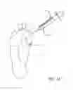 Fig. 02 - System and methods for soft-tissue augmentation