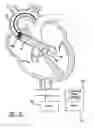 Fig. 10 - Intravascular ventricular assist device