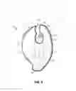 Fig. 07 - Catheter placement assist device and method of use