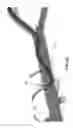 Fig. 35 - Method and apparatus for treating fluid build-up in a body cavity, including method and apparatus for treating ascites and pleural effusions