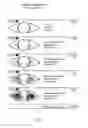 Fig. 02 - Electrode system, device and method for the treatment of eye diseases, in particular dry eye