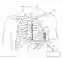 Fig. 01 - Tachyarrhythmia induction by an extra-cardiovascular implantable cardioverter defibrillator