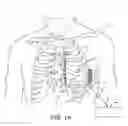 Fig. 02 - Tachyarrhythmia induction by an extra-cardiovascular implantable cardioverter defibrillator