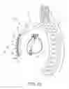 Fig. 03 - Tachyarrhythmia induction by an extra-cardiovascular implantable cardioverter defibrillator