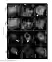 Fig. 07 - Phosphoinositide (4,5) Bisphosphate as a Diagnostic Tool and Target for Cancer Treatment