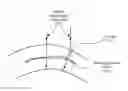 Fig. 01 - Intrastromal surgery correcting low order and high order aberrations of the eye