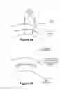 Fig. 02 - Intrastromal surgery correcting low order and high order aberrations of the eye