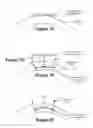 Fig. 03 - Intrastromal surgery correcting low order and high order aberrations of the eye