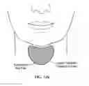 Fig. 131 - Pixel array medical systems, devices and methods