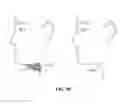 Fig. 85 - Pixel array medical systems, devices and methods