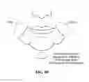 Fig. 89 - Pixel array medical systems, devices and methods