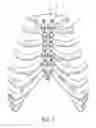 Fig. 02 - Bone Fixation Implants