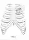 Fig. 03 - Bone Fixation Implants