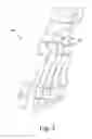 Fig. 04 - Surgical instrument and method for use in sizing fixation implants